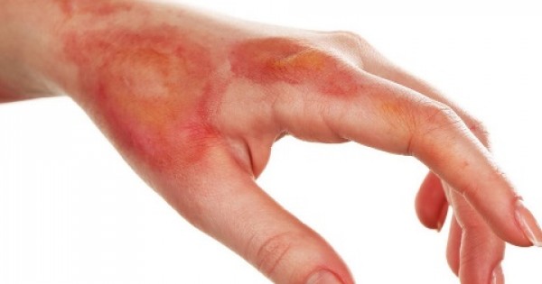 az ujjak közötti égési sérülések kezelése)